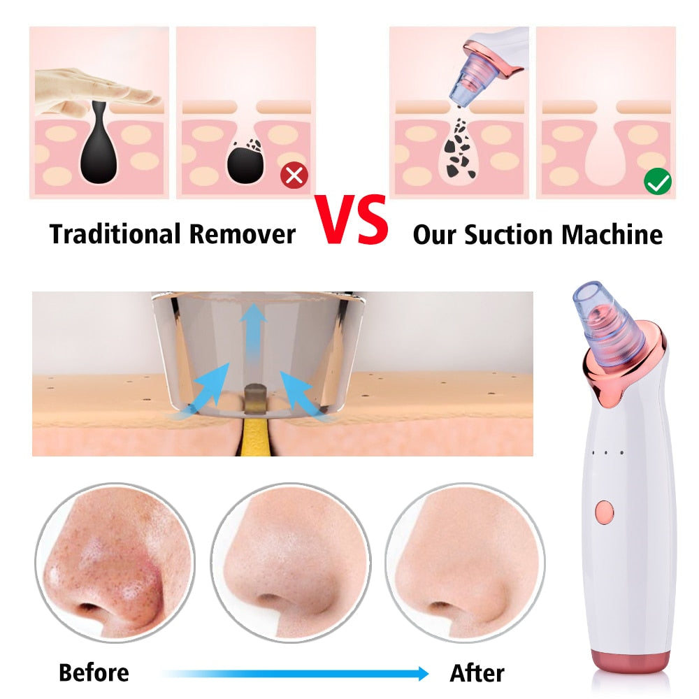 Blackhead Remover Vacuum Acne Pimple Removal Suction + Free Blackhead Removal Tool Kit